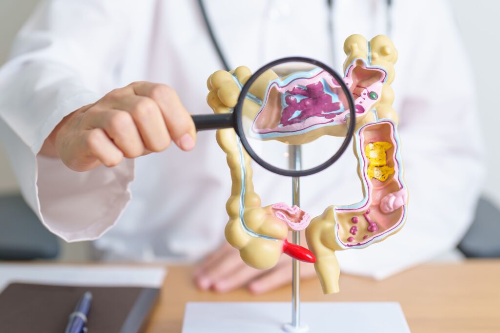 Mimub Advertencia del Cirujano General sobre la Diverticulitis: Un Problema Común en Personas Mayores de 50 Años
